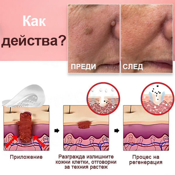 🌟 KUBOZN® Нано-микроиглени лепенки за премахване на кожни образувания